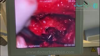 عمل جراحی دیسک far lateral