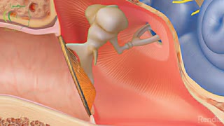 اتواسکلروز