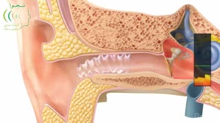 درمان اتواسکلروز