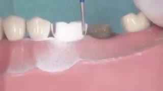 نحوه تراش روکش دندان