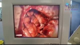 فیلم جراحی اپیدرموئید دخترخانم ۲۱ ساله با اختلال بینایی چشم چپ