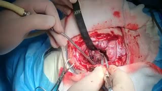 فیلم جراحی ضایعه عروقی مغز در دختر جوان