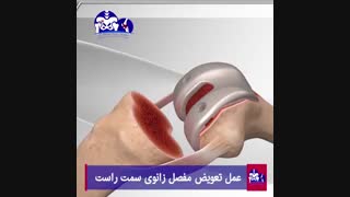 فیلم واقعی و مستند عمل تعویض مفصل زانو سمت راست