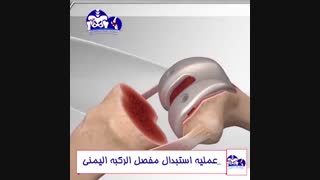 عملیه استبدال مفصل الرکبه الیمنی