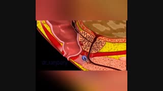 انیمیشن درباره سرطان پروستات