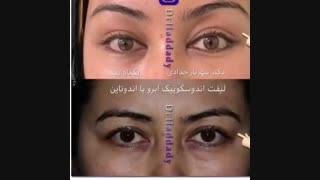 لیفت ابرو با اندوتاین