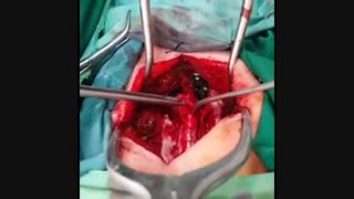 تترد کورد ستون فقرات گردنی