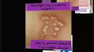درمان قطعی زگیل تناسلیhpv چیست ؟؟؟
