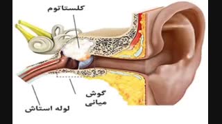کلستاتوم_سمعک برتر ۰۲۱۲۲۹۰۹۲۱۶