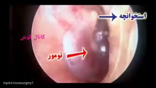 تومور گوش میانی_سمعک برتر 02122909216