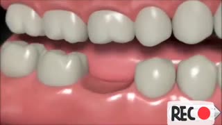 جایگزین دندان از دست رفته