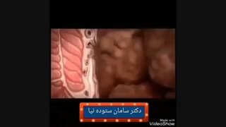 علت شایع بواسیر