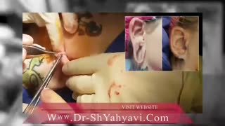 جراحی ترمیم گوش | دکتر یحیوی