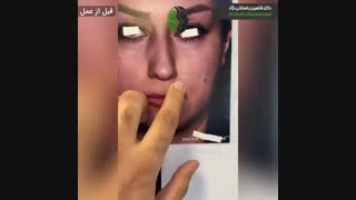 جراحی زیبایی بینی در بیمار با عدم تقارن دو سمت بینی  | دکتر باستانی نژاد
