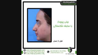 جراحی بینی پیچدار با سابقه شکستگی