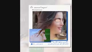نمونه جراحی زیبایی بینی در اردبیل