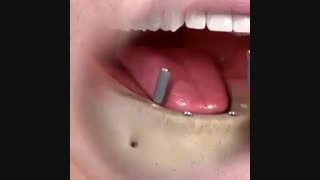 انیمیشن ایمپلنت دندان