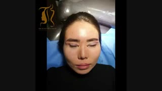 جراحی پلک آسیایی