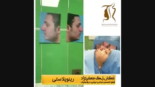 رینوپلاستی