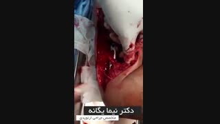 جراحی خورد شدگی شدید بازو