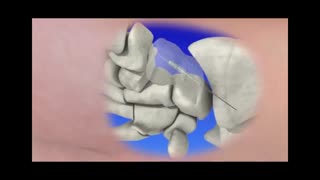 شکستگی استخوان اسکافوئید یا ناویکولار مچ دست و روش درمان