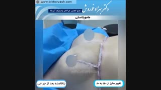 فیلم ماموپلاستی