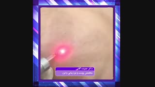 برداشت خال با لیزر اکستنشن تاج دندان