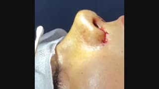 جراحی بینی همراه با تزریق چربی به چانه