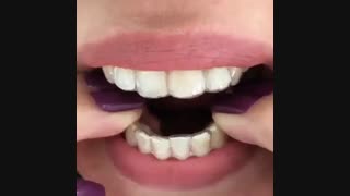 نایت گارد جهت جلوگیری از دندان قروچه و سایش دندانها به همدیگر