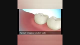 جراحی دندان عقل