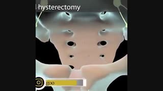 ازاله الغرز الاباروسکوب