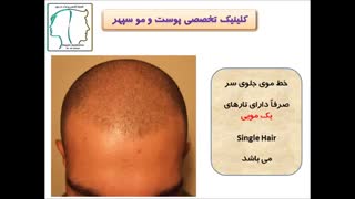 خط موی جلوی سر در کاشت موی طبیعی