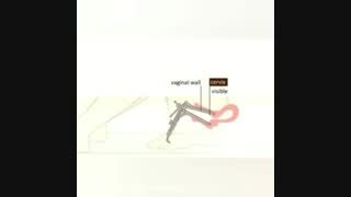 انیمیشن درباره پاپ اسمیر