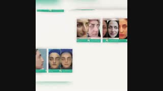 تصاویر جراحی بینی انجام شده توسط دکتر عبدالرضا روئین تن ، فوق تخصص جراحی پلاستیک