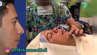 جراحی بینی و پروتز چانه توسط دکتر گلی بهترین جراح بینی تهران