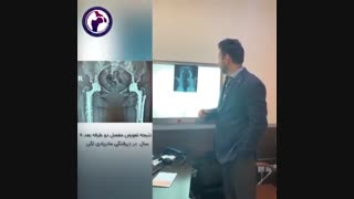 نتیجه تعویض مفصل دو طرفه بعد ۸ سال در دررفتگی مادرزادی لگن