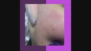 میکرونیدلینگ به همراه مزوتراپی جهت رفع لک و جای جوش لیپوست