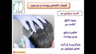مزوتراپی مو