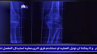 الحیاه العادیه بعد عملیه استبدال مفصل الرکبه
