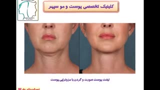 مزوتراپی پوست