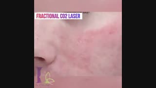 نحوه عملکرد لیزر فرکشنال رادیوگرافی دندان