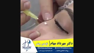 جوانسازی دور چشم با نخ pdo