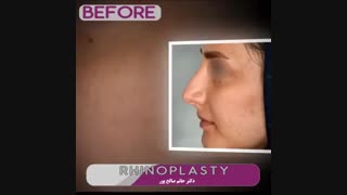 دوماه بعد از جراحی بینی