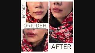 تزریق ژل لب در کلینیک زیبایی ارکیده