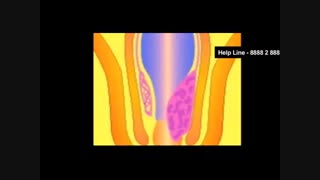 بهترین گزینه‌های درمان سریع بواسیر خارجی - کلینیک پایتخت