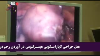 عمل جراحی لاپاراسکوپی هیسترکتومی در آوردن رحم