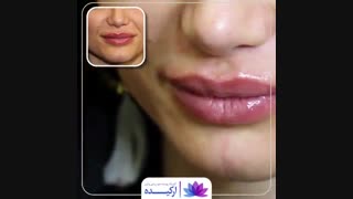 تزریق ژل لب در کلینیک ارکیده