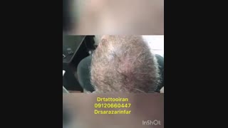 میکرو اسکالپ سر | 