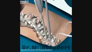 درمان انحراف ستون فقرات اسکولیوز