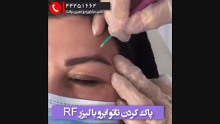 پاک کردن تتو با RF